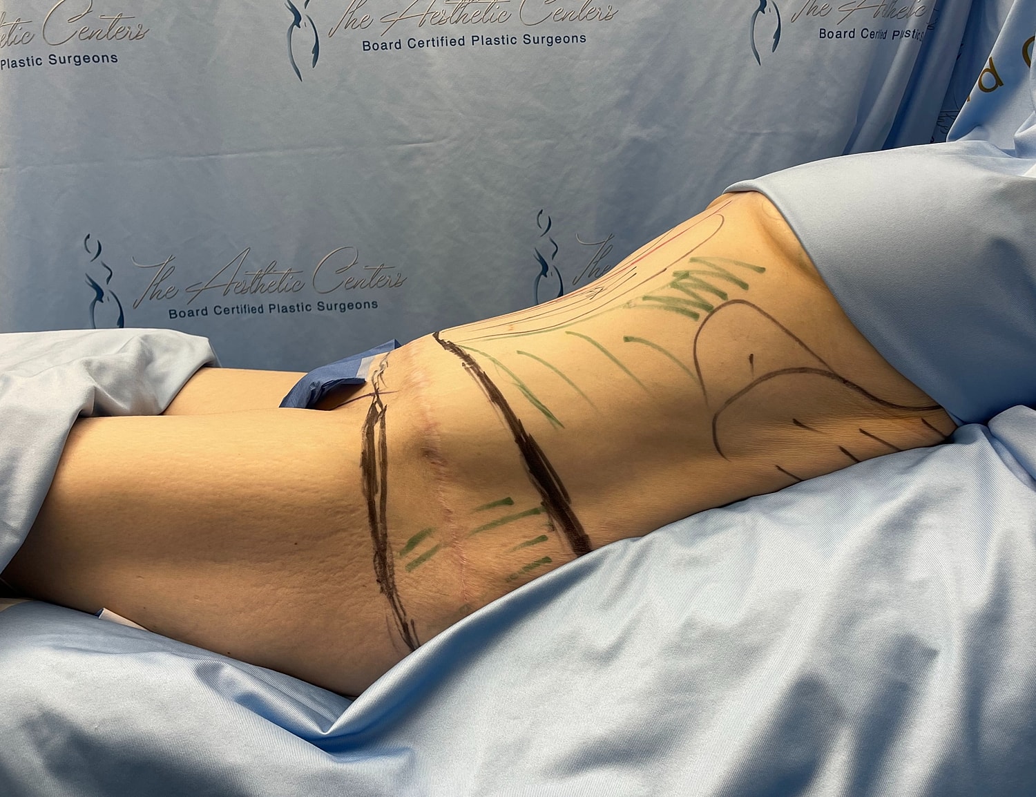 Patient prep for plastic surgery procedure.