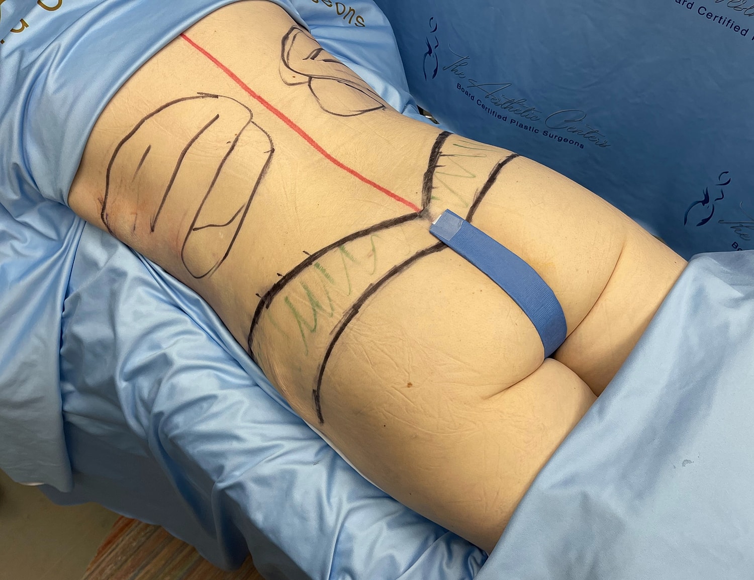 Surgical markings on a patient's back for procedure.