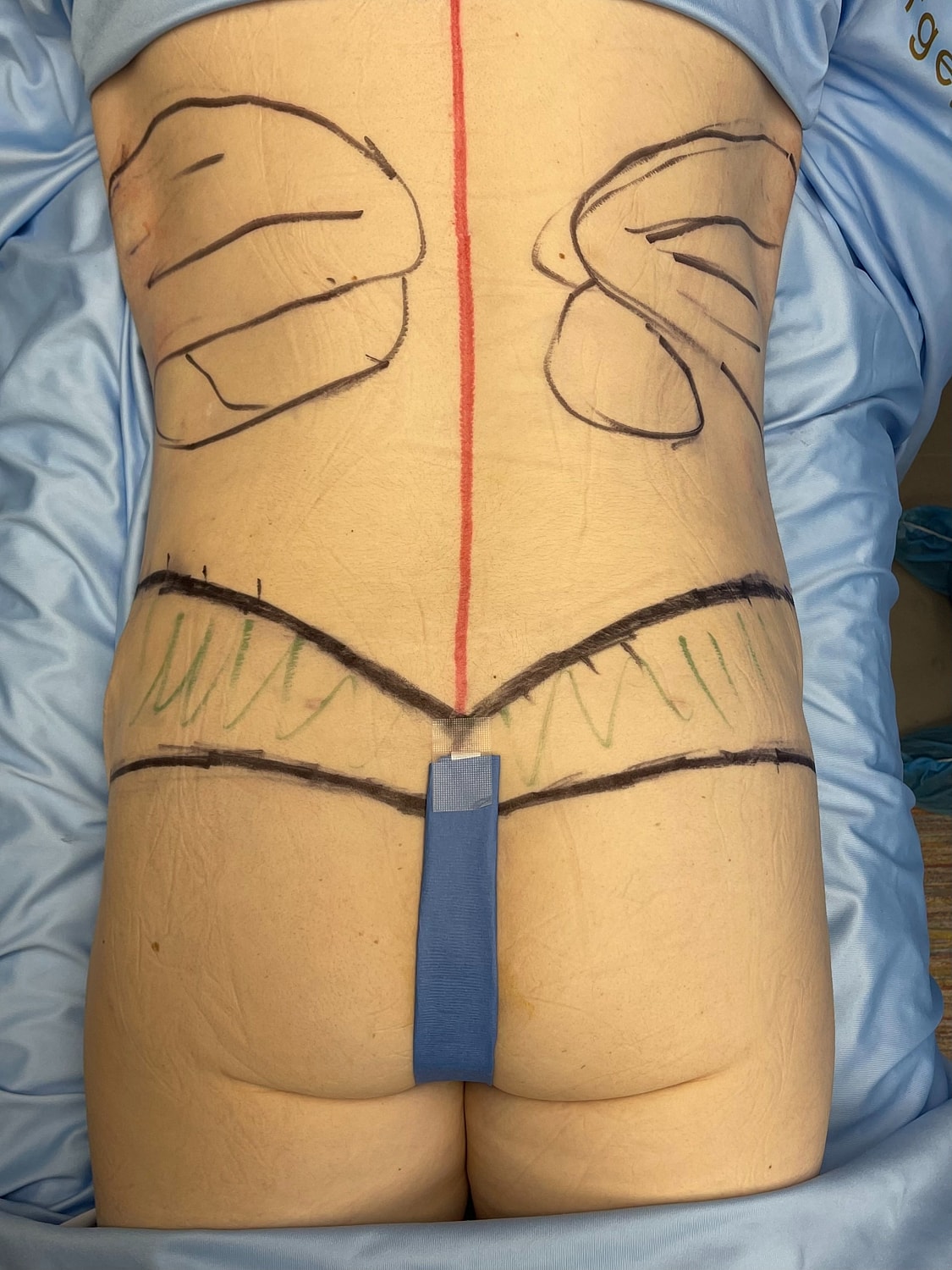 Surgical markings on a patient's back.