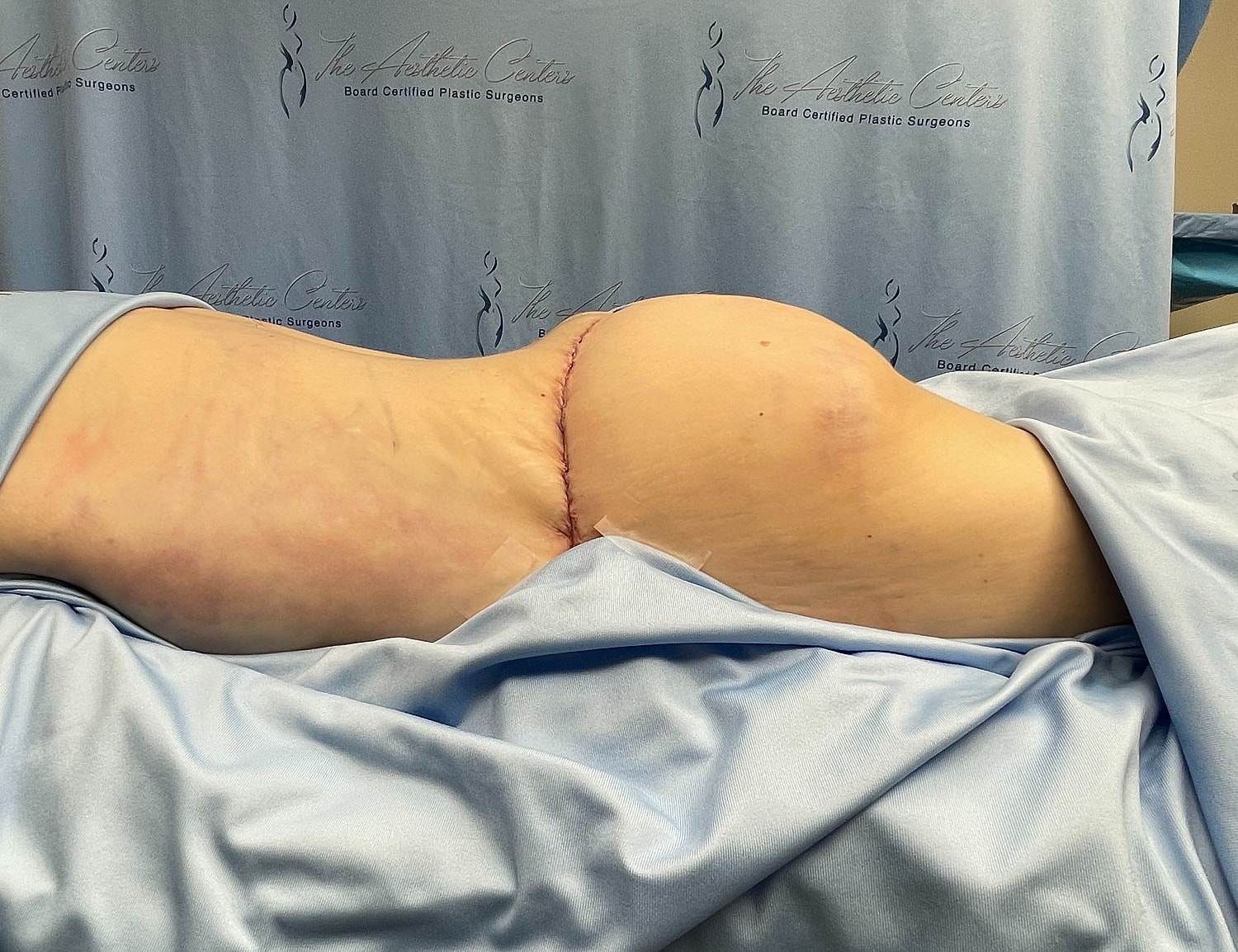 Post-surgical body contouring procedure recovery image.