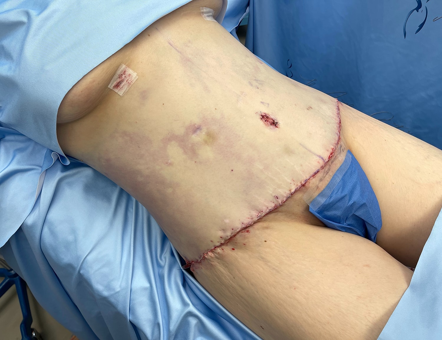 Surgical wound on lower abdomen after procedure.