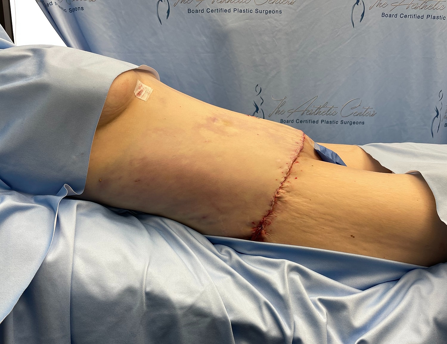 Surgical incision on patient’s torso after procedure.