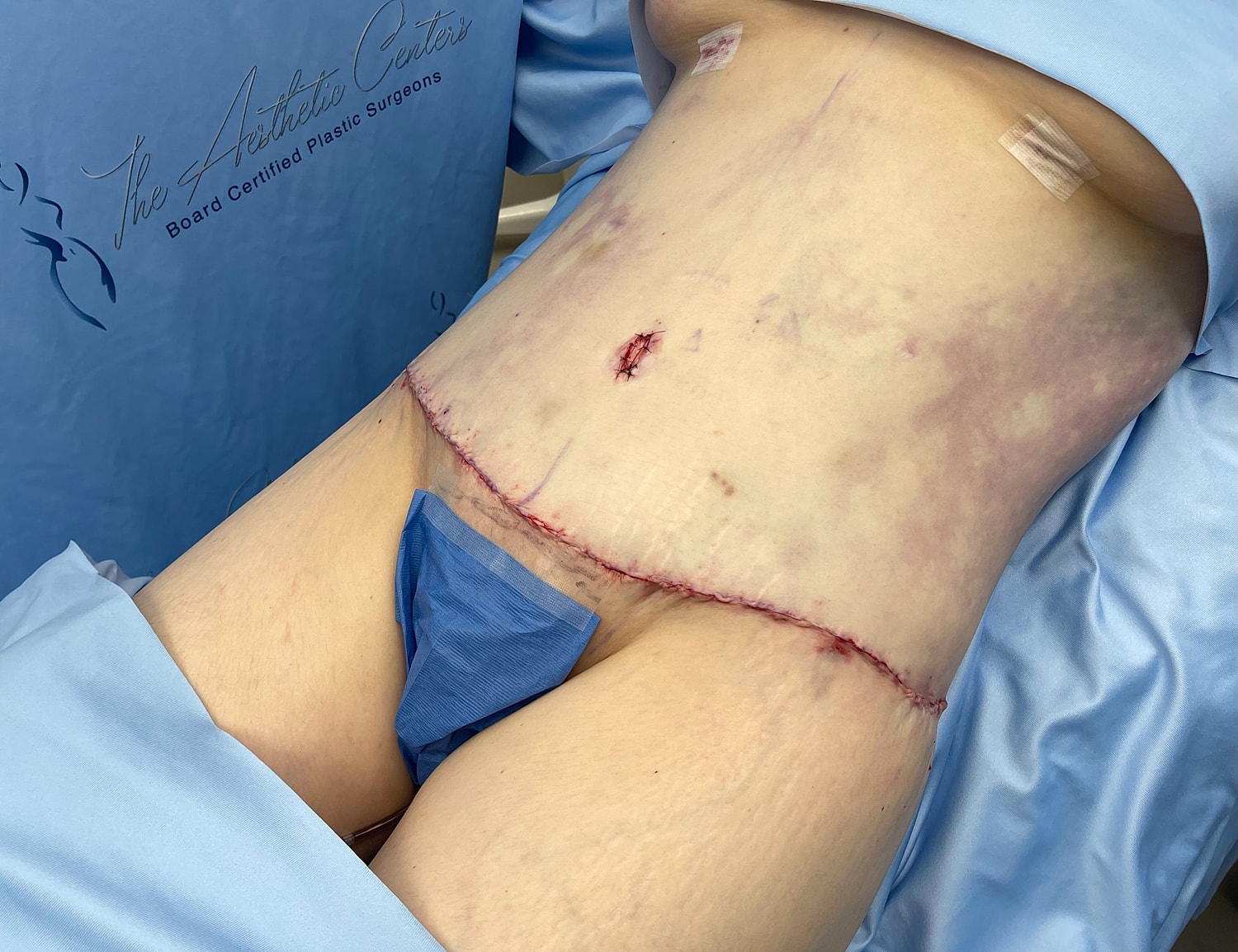 Post-surgery abdomen with visible stitches and dressings.