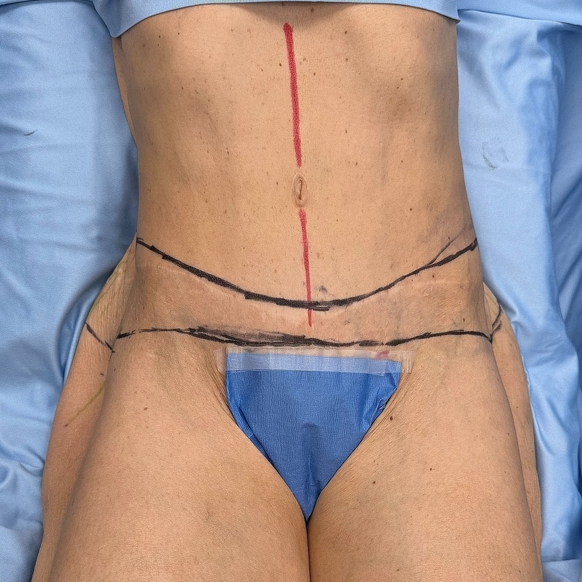Surgical markings on abdomen and thighs.