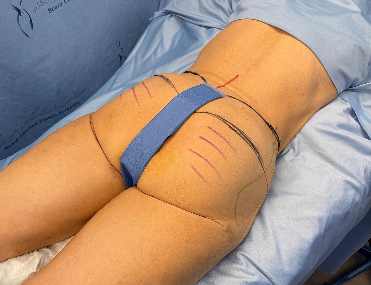 Patient preparing for cosmetic surgery procedure.