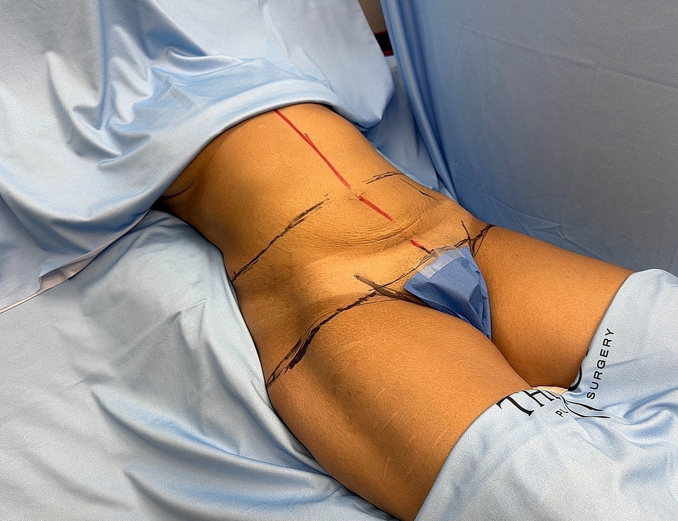 Surgical markings on patient’s lower abdomen.