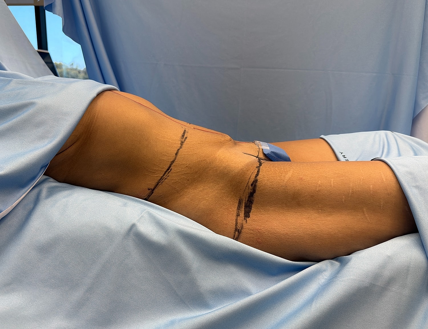 Patient lying down with surgical markings visible.