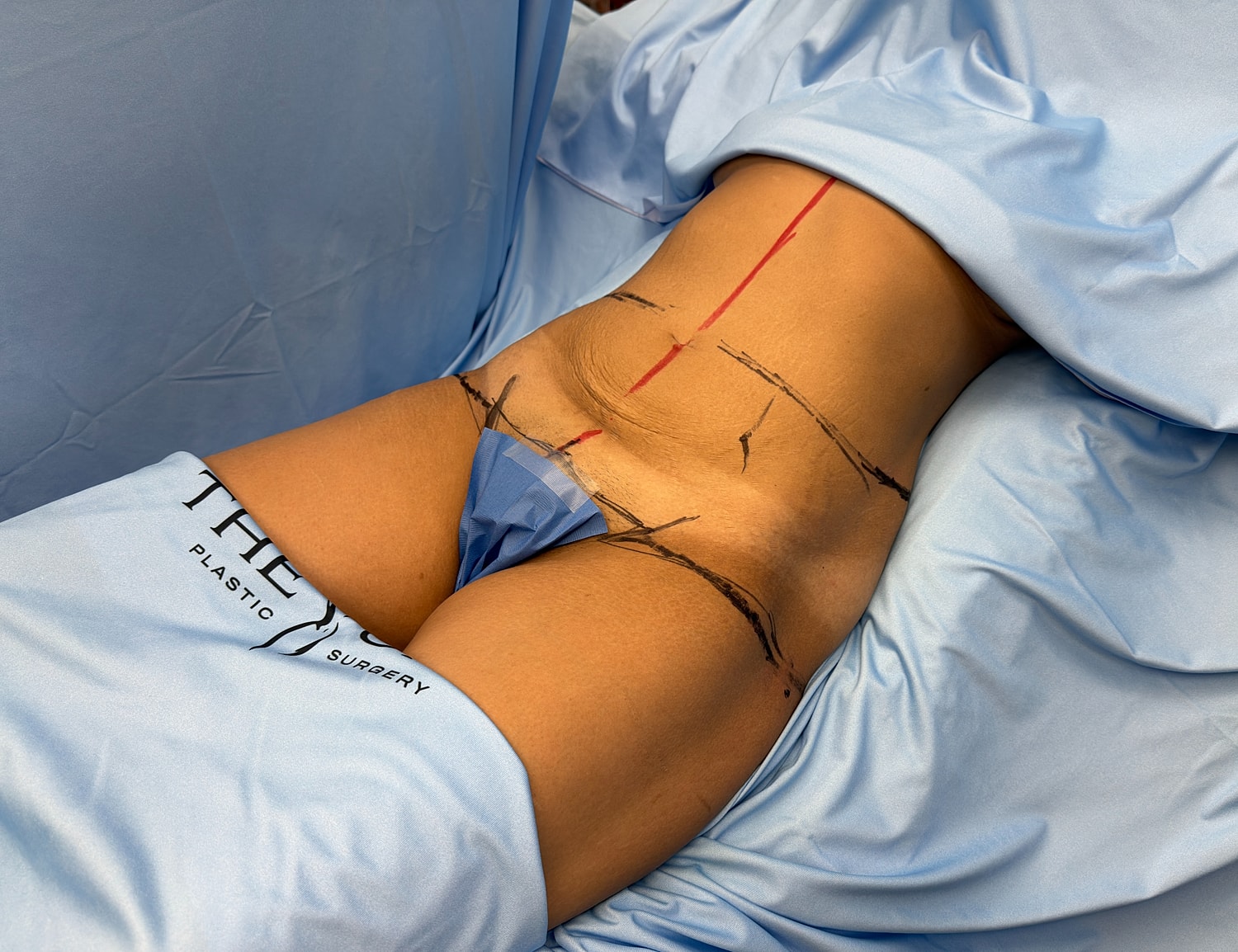 Surgical prep for body contouring procedure.
