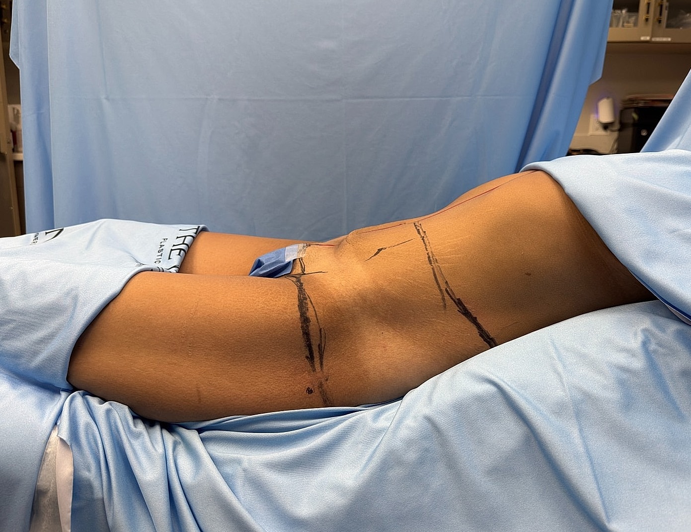 Patient in surgical position with markings on skin.