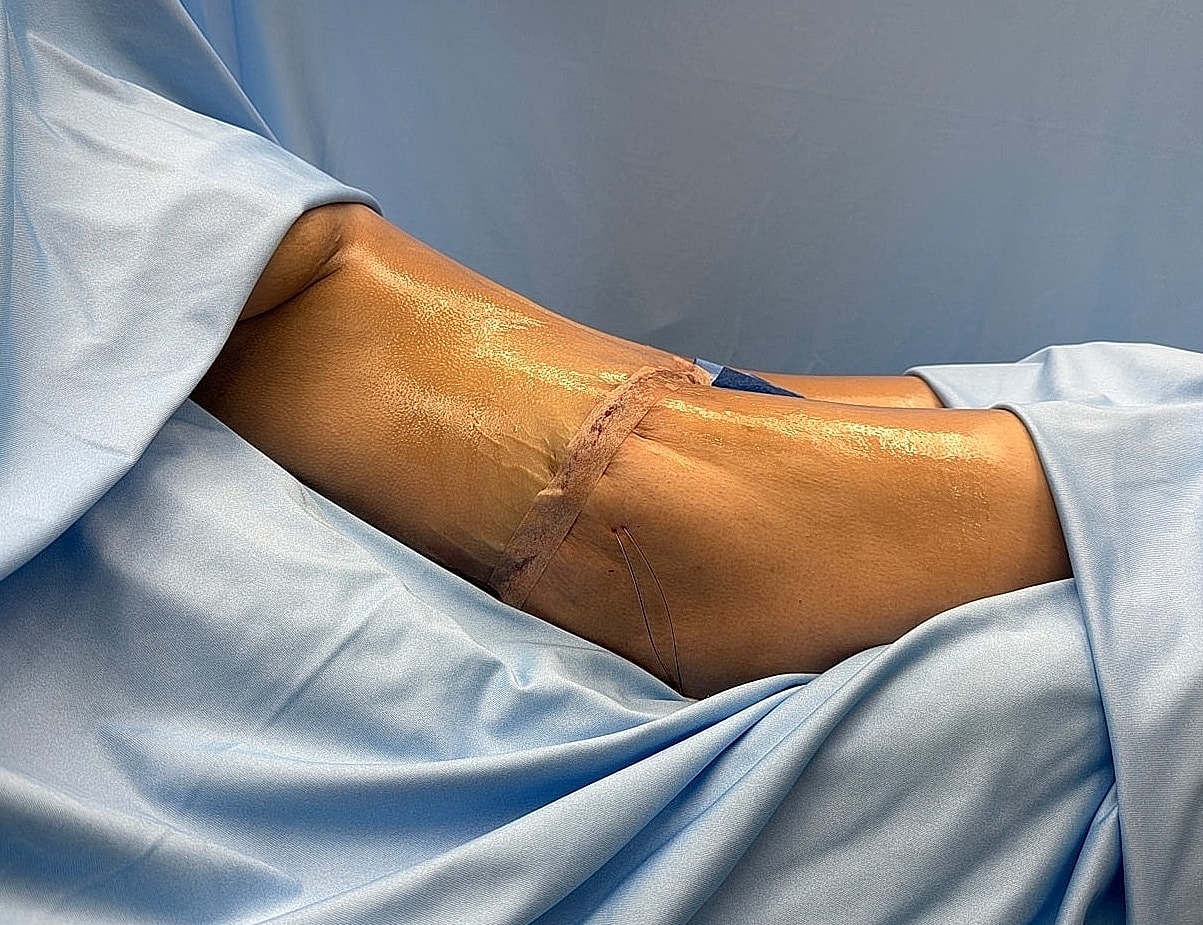 Post-surgery leg with dressing and sutures visible.