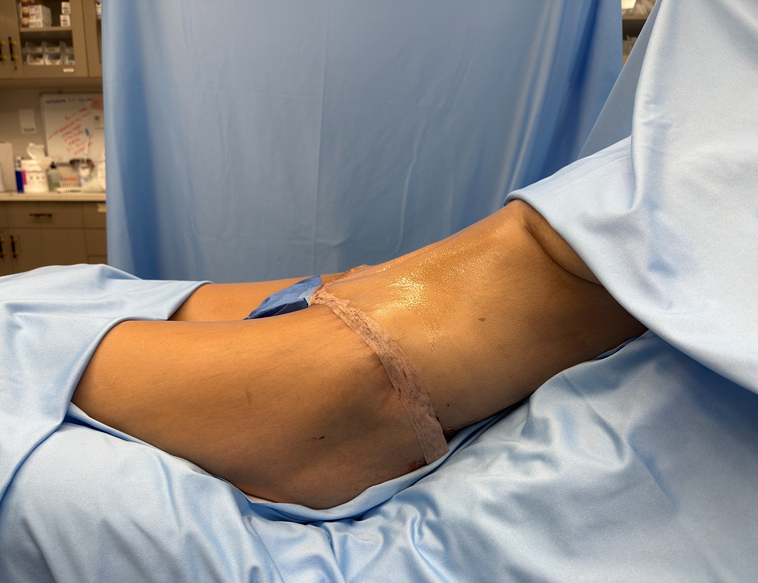 Medical procedure on a patient’s leg.