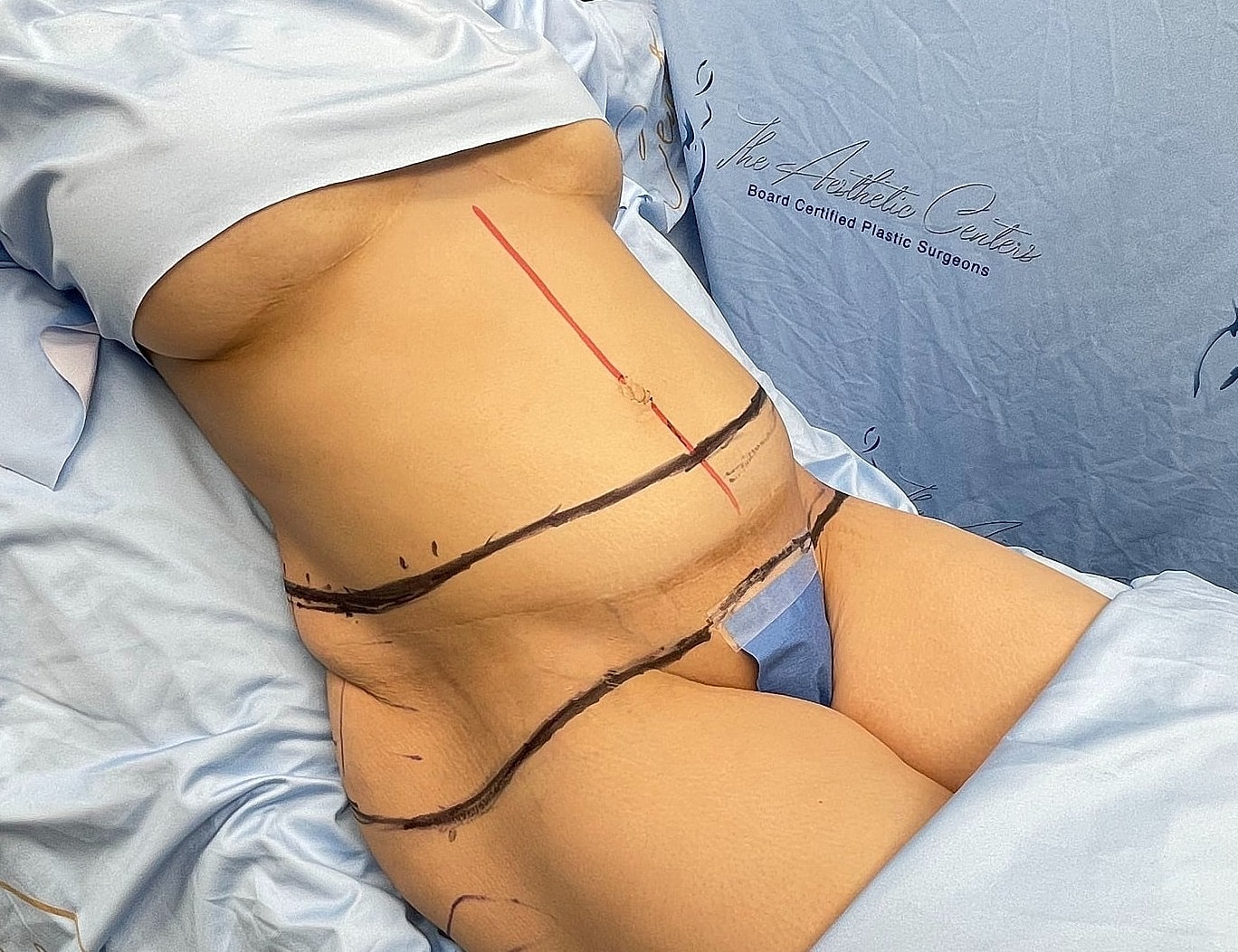 Pre-surgery markings on patient's abdomen.