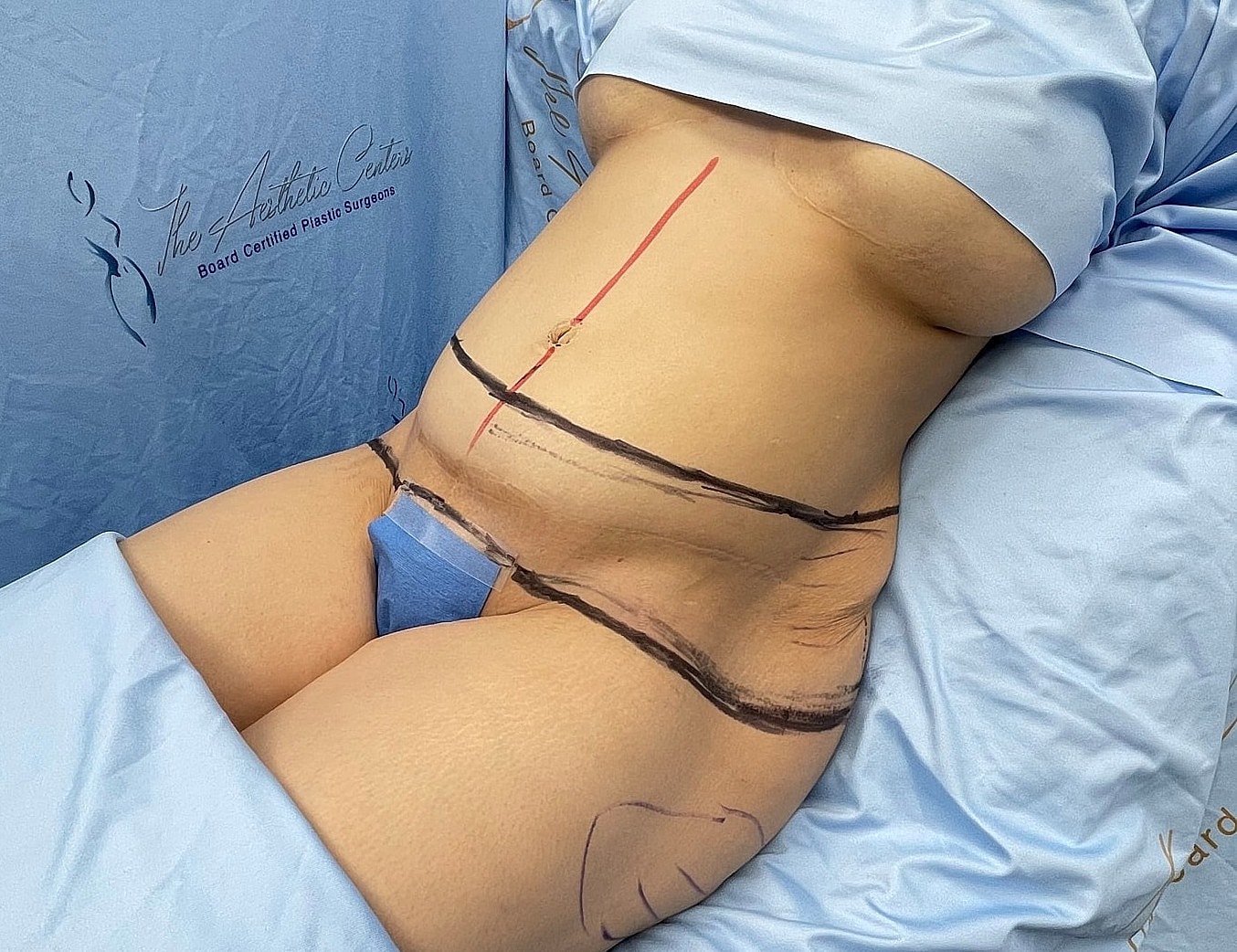 Patient preparing for plastic surgery procedure marked area.