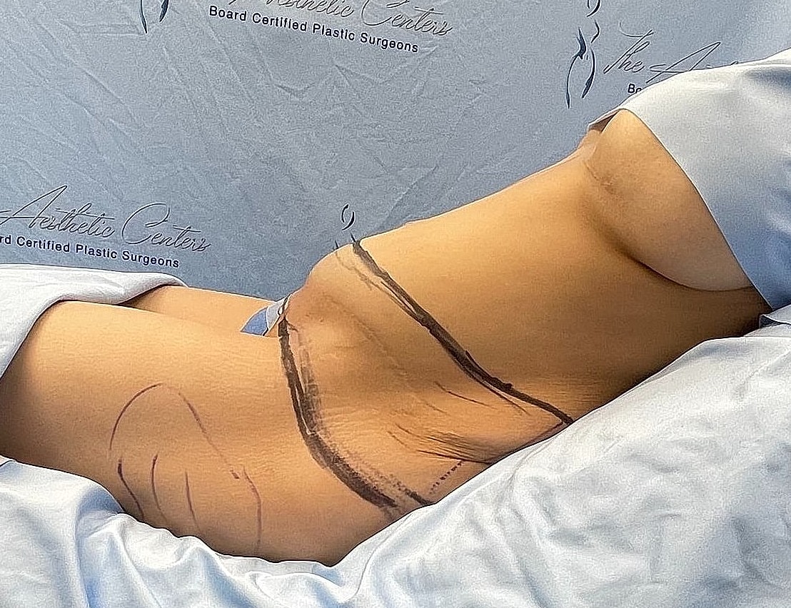 Patient preparing for plastic surgery consultation session.