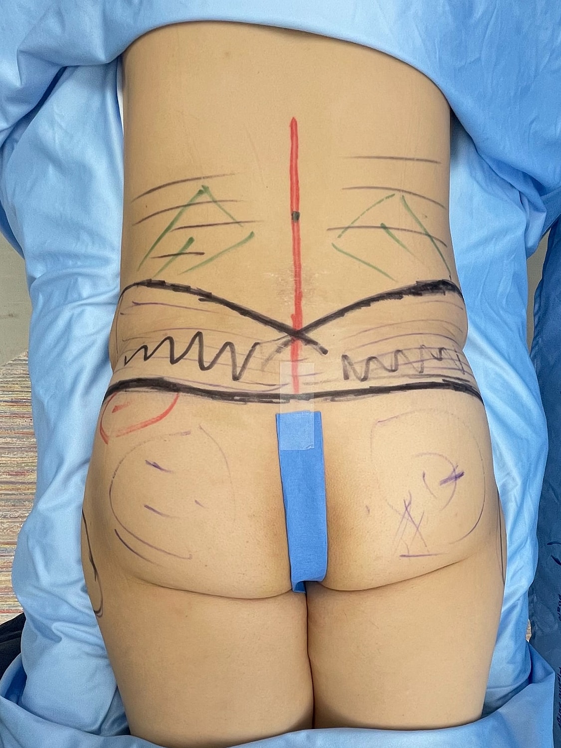 Body markings for a cosmetic procedure preparation.
