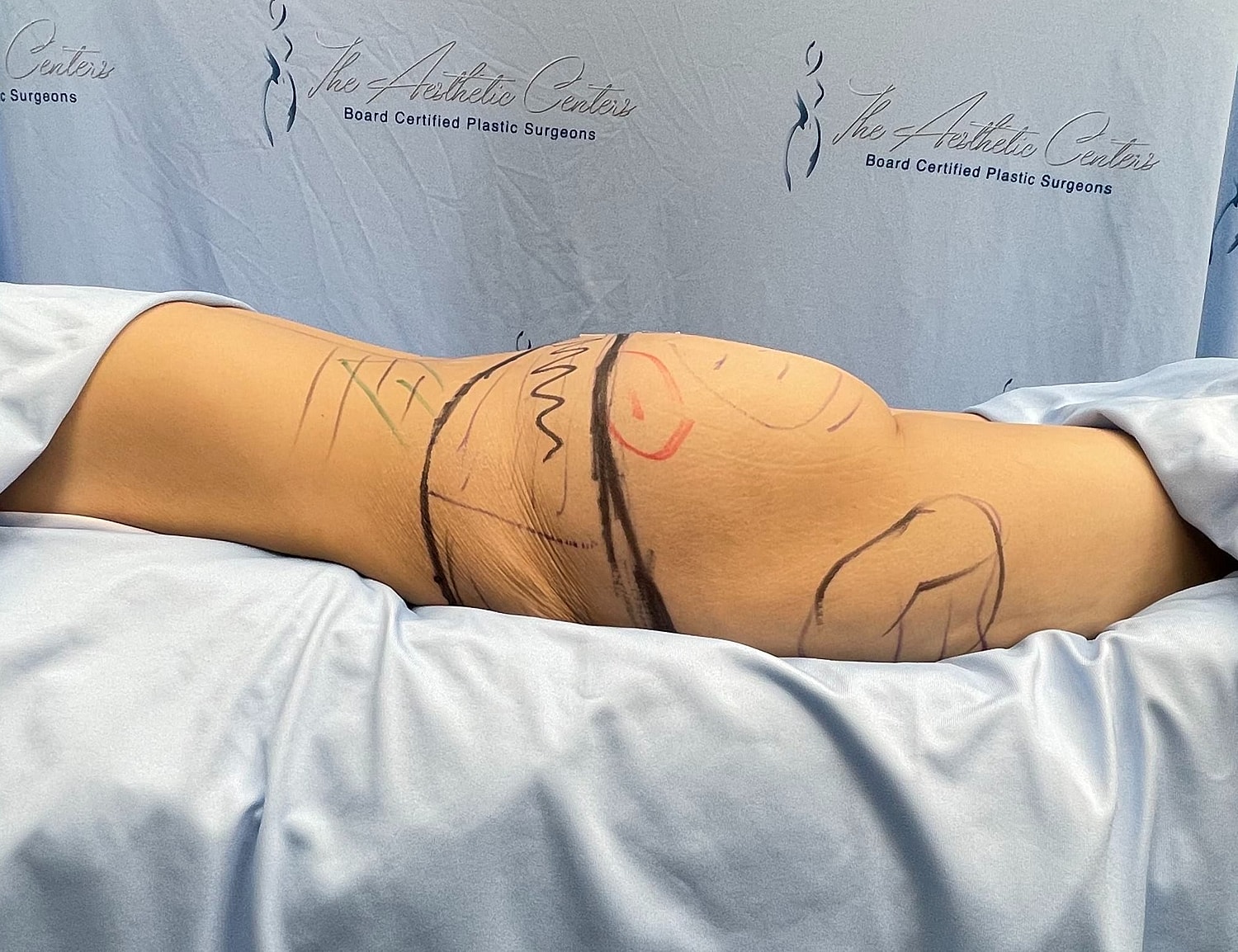 Body marked for aesthetic procedure preparation.
