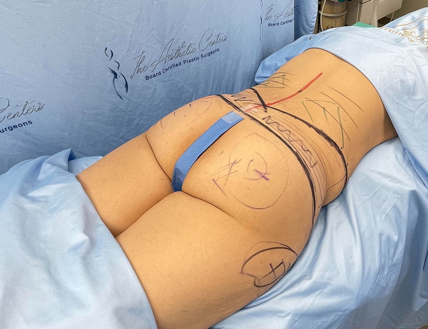 Pre-surgical markings on a patient's lower back.