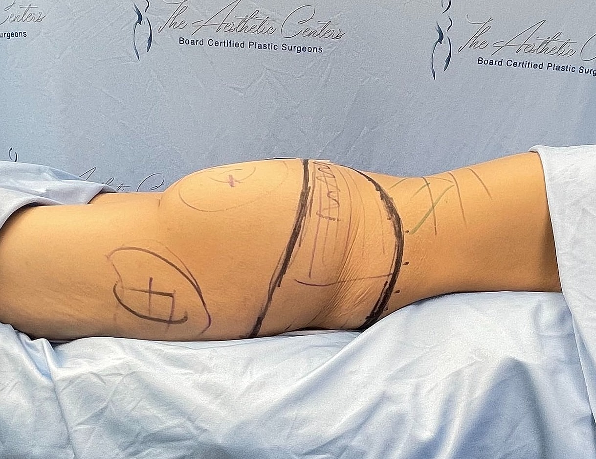 Labeled leg preparation for medical procedure.