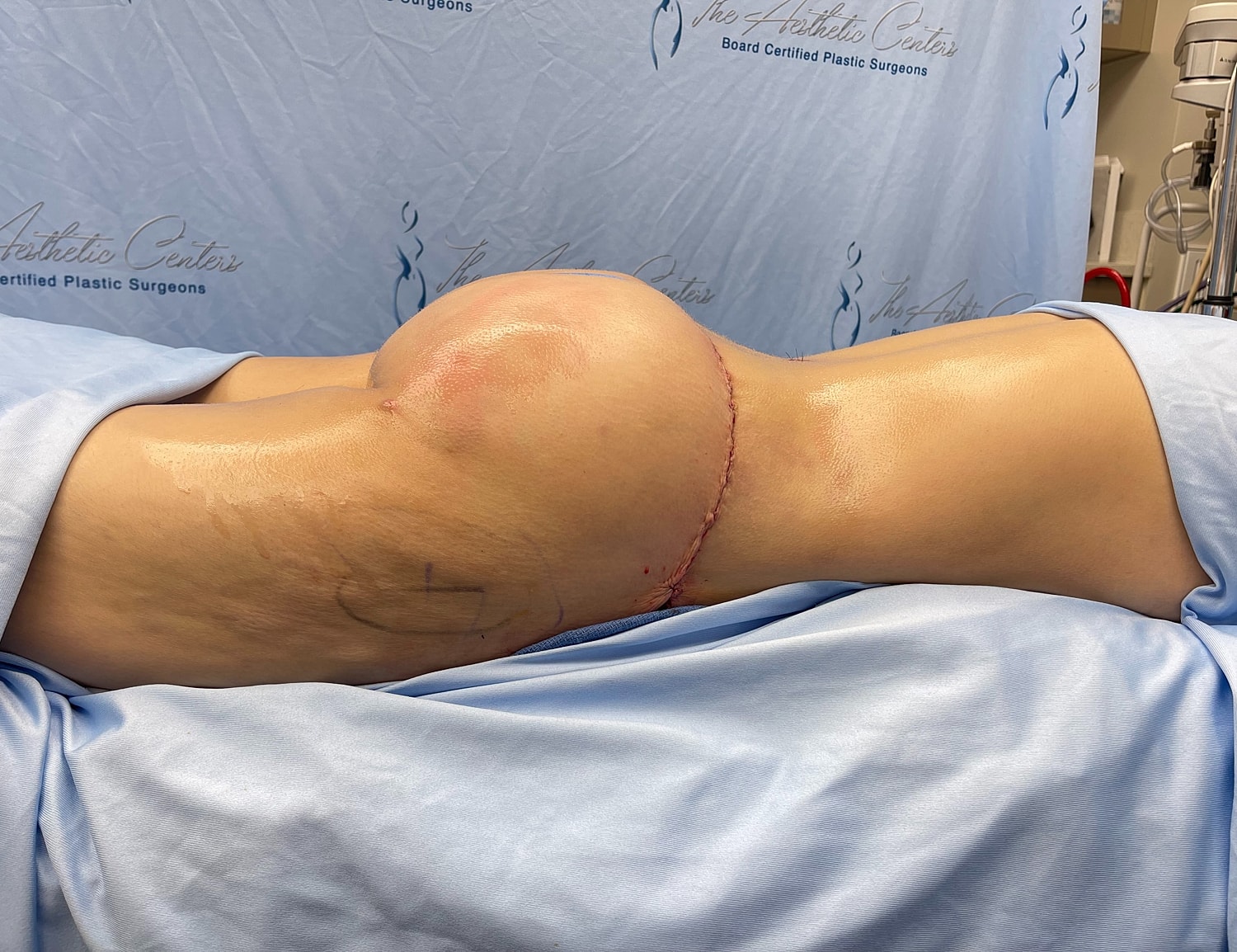 Post-surgery image of hip augmentation procedure.