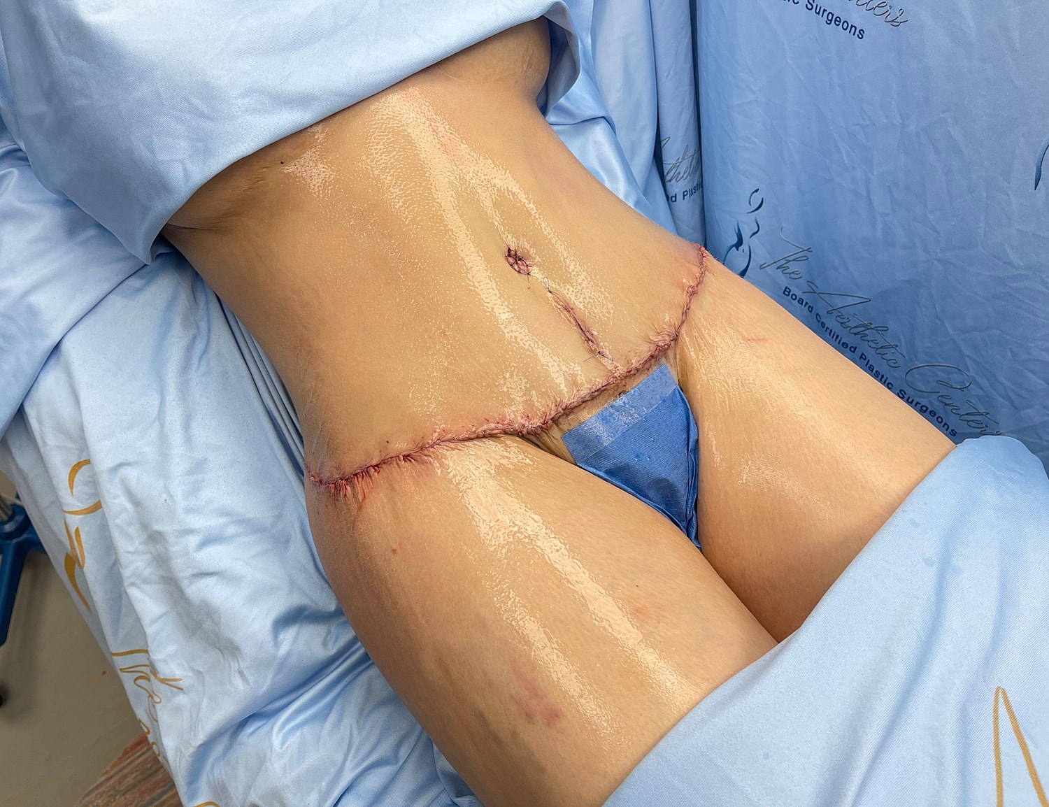 Surgical wound on abdomen after a procedure.