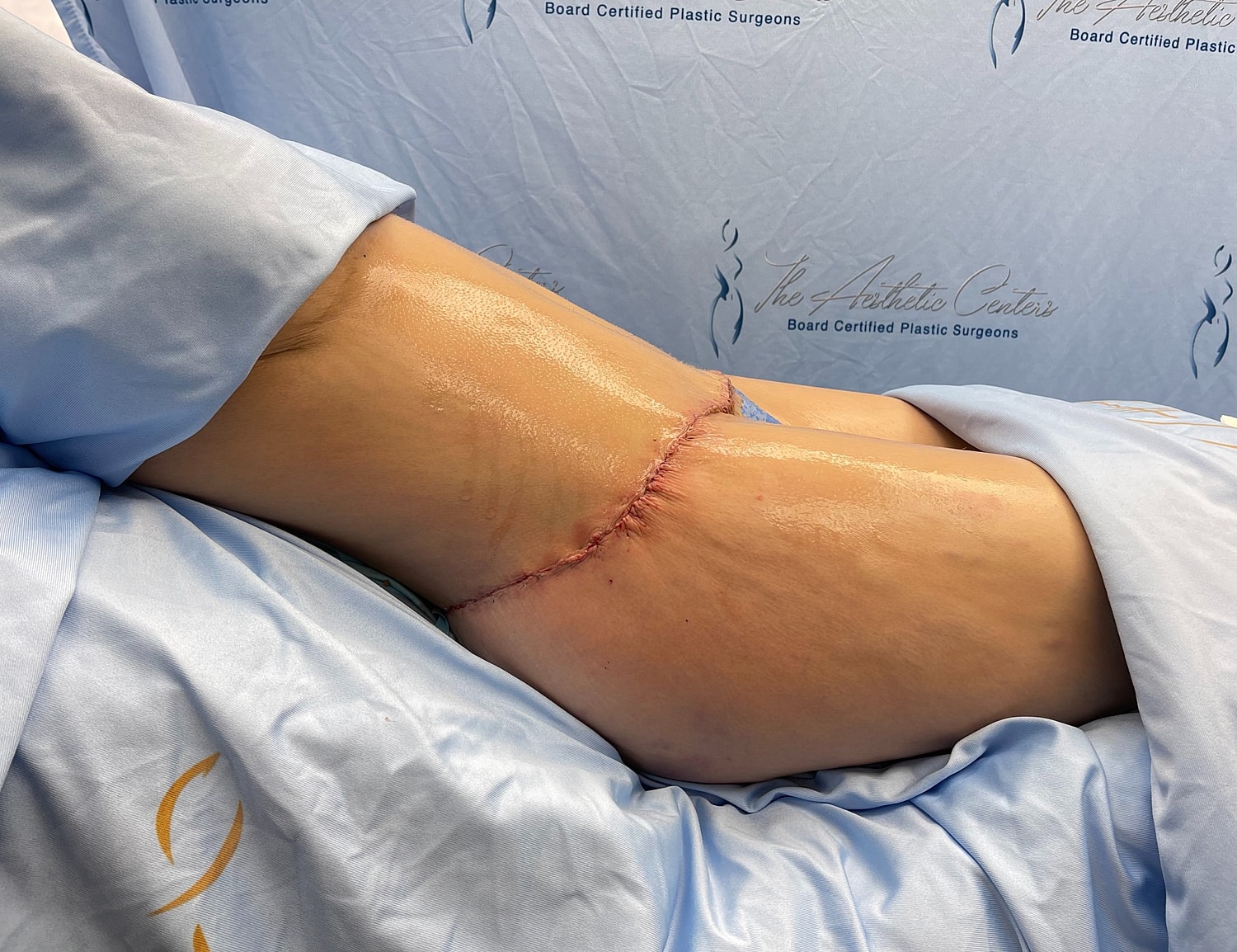 Surgical site post-operation on patient’s leg.