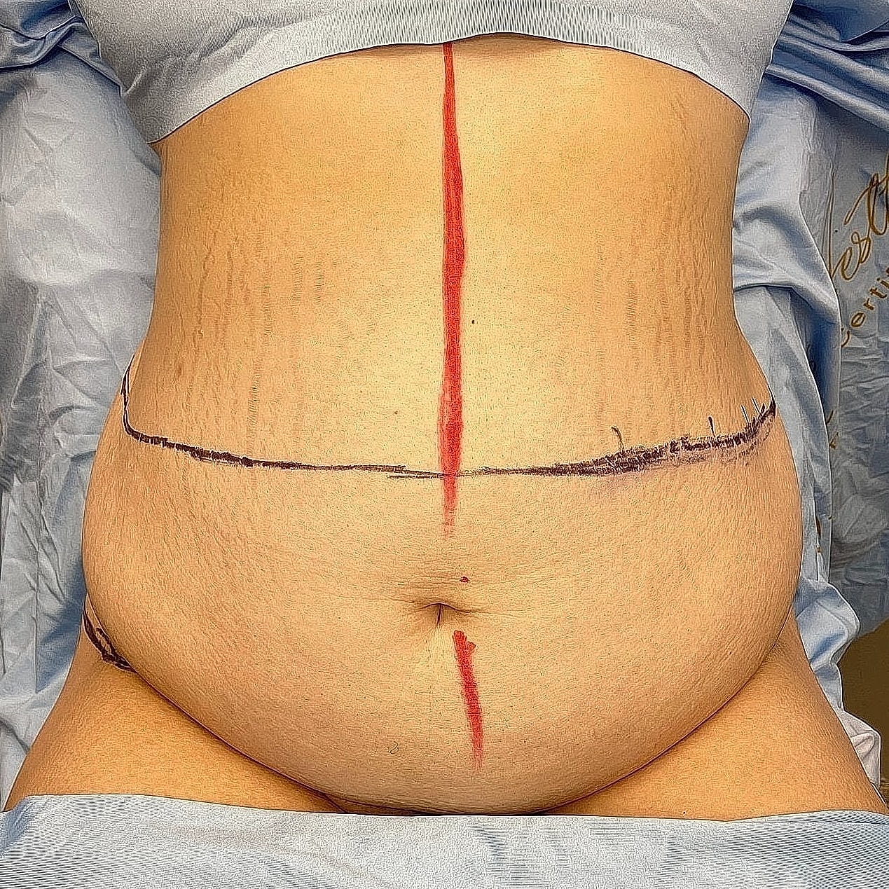 Surgical markings on a patient's abdomen.