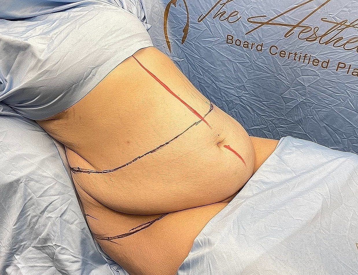 Surgical markings on abdomen before procedure.