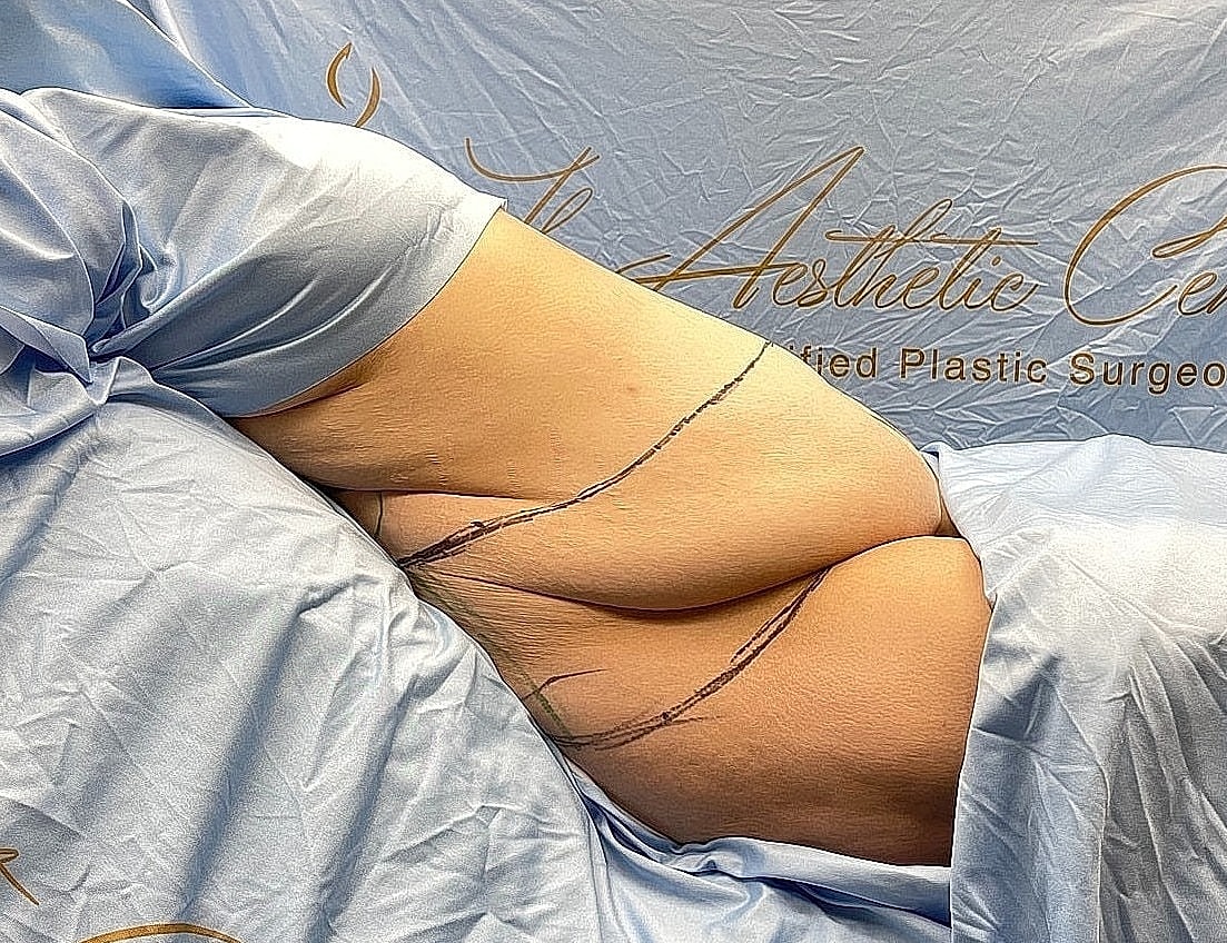 Patient preparing for surgical procedure in clinic.