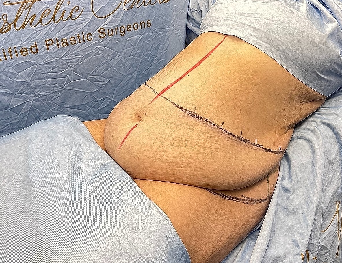 Patient preparing for body contouring procedure.