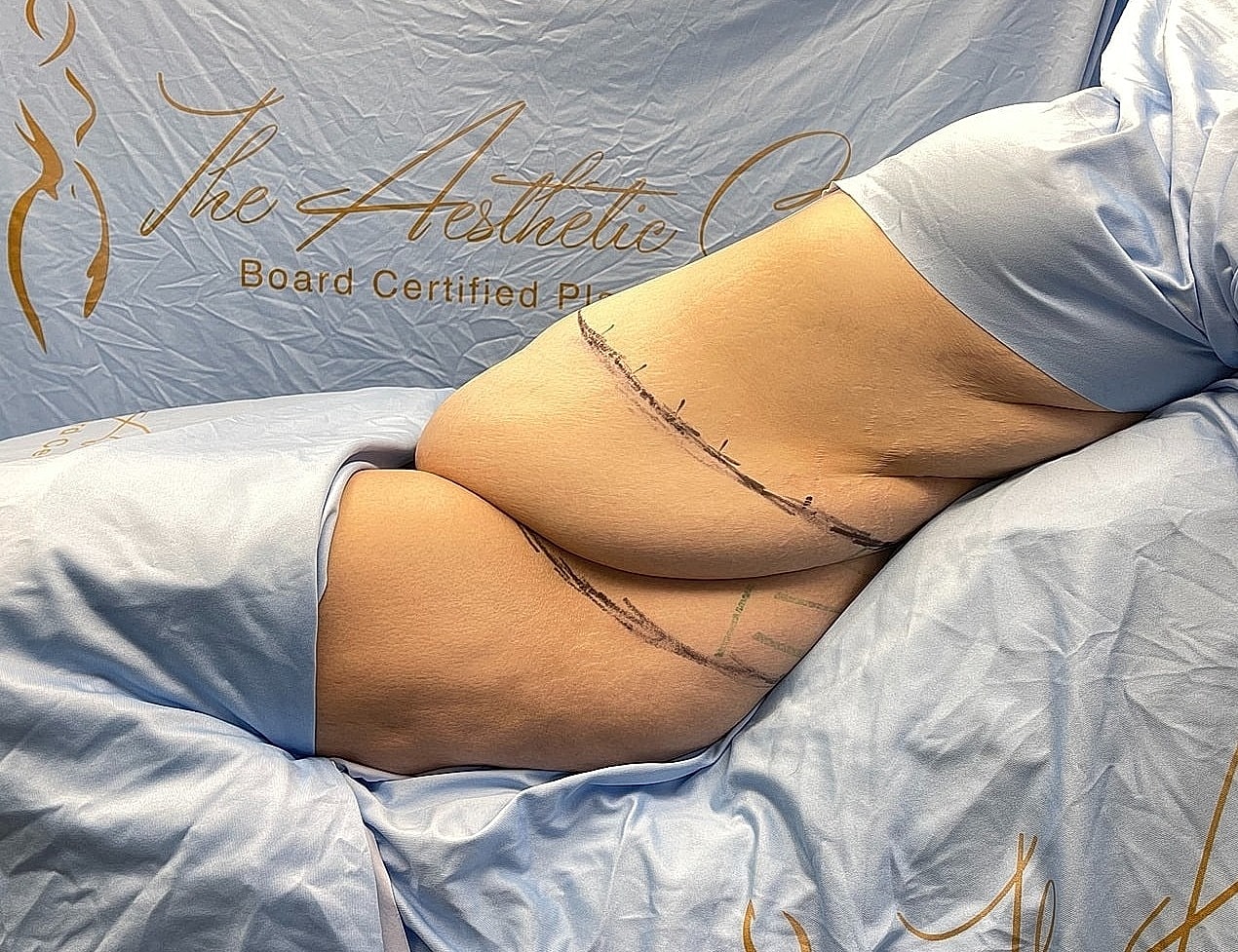 Patient preparing for a cosmetic procedure.