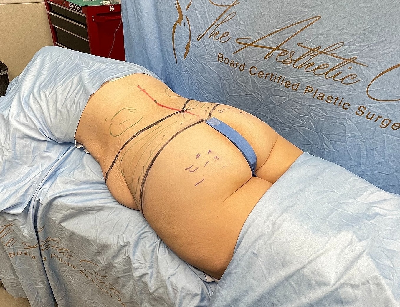 Body contouring procedure preparation in clinical setting.