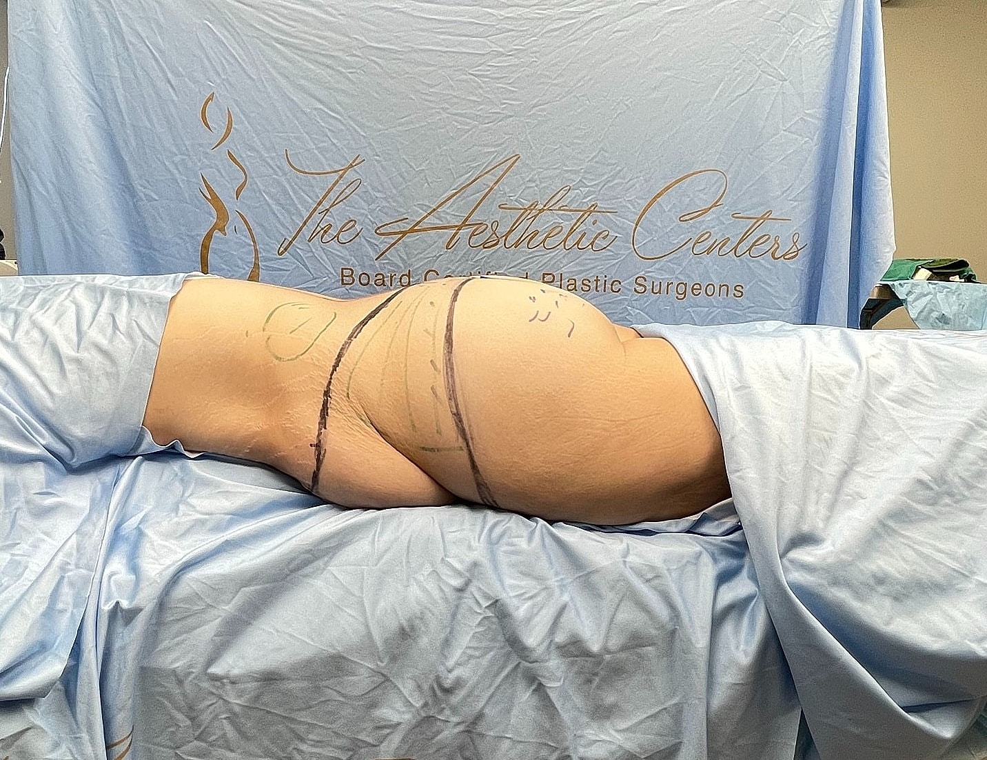 Patient prep for cosmetic surgery procedure illustration