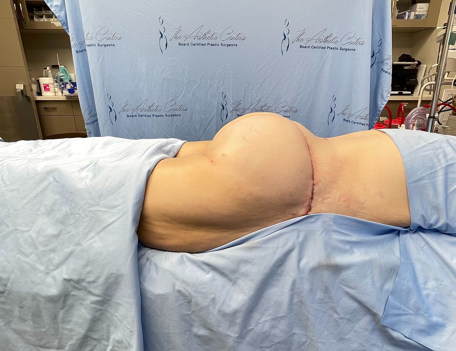 Post-surgery body contouring procedure in clinic.