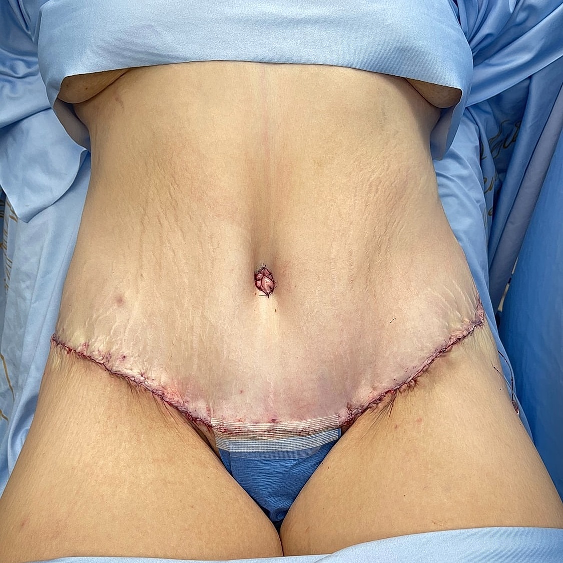 Surgical incision on abdomen post-operation.