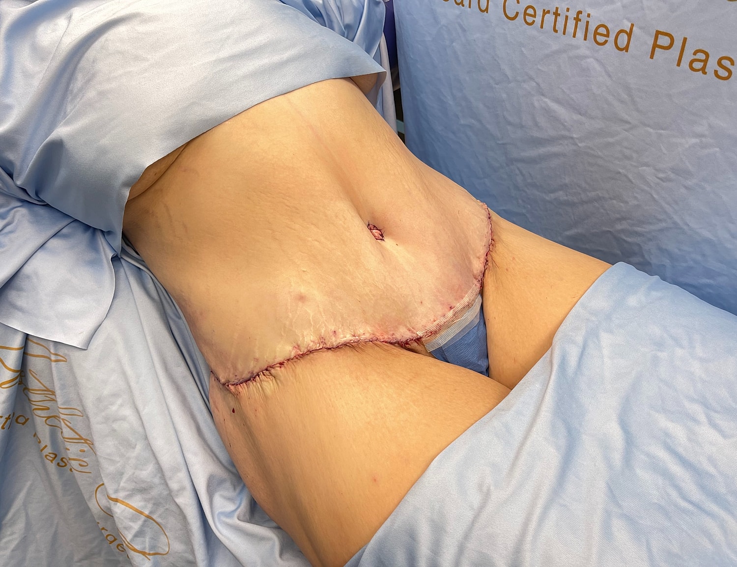 Surgical incision on abdomen post-operation.