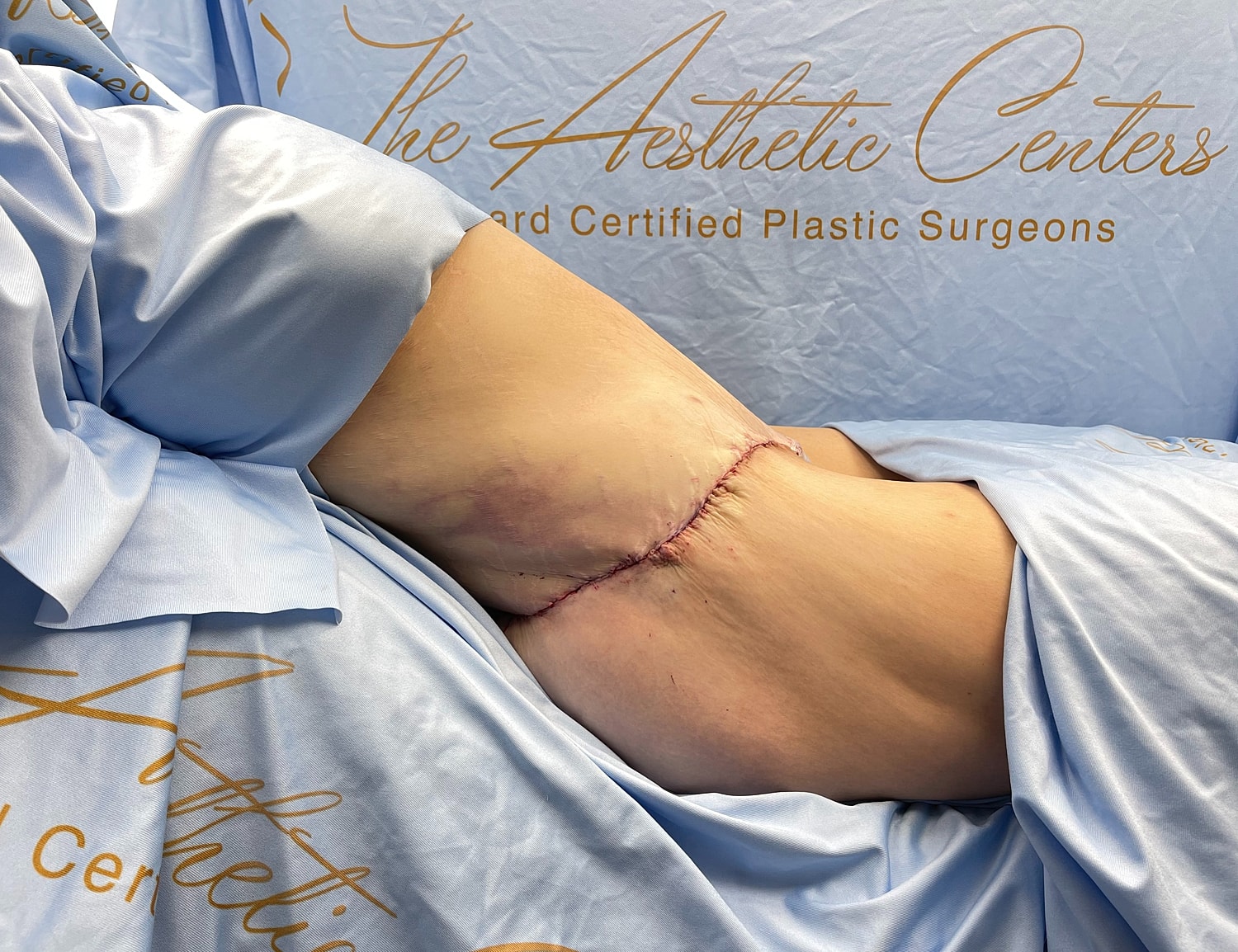 Surgical incision on patient’s abdomen post-operation.