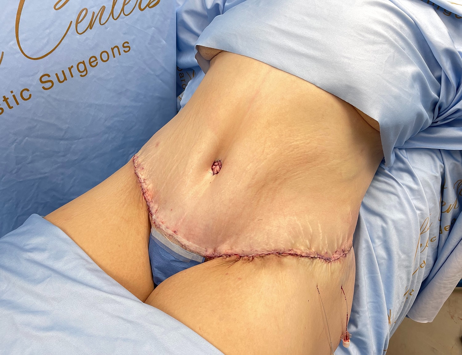 Surgical site with stitches on abdominal area.