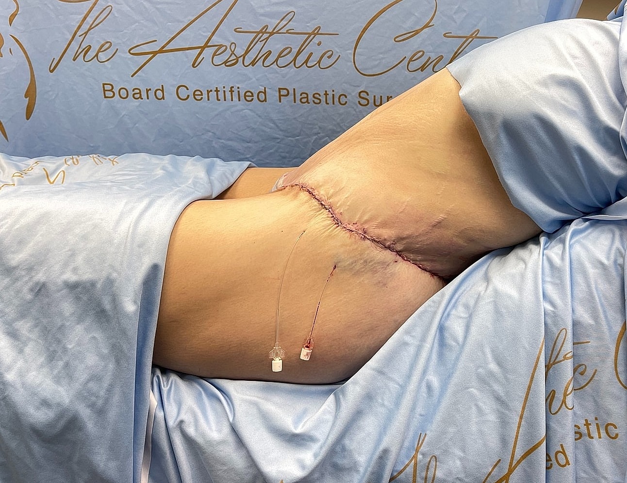 Post-surgery recovery with visible stitches and dressings.