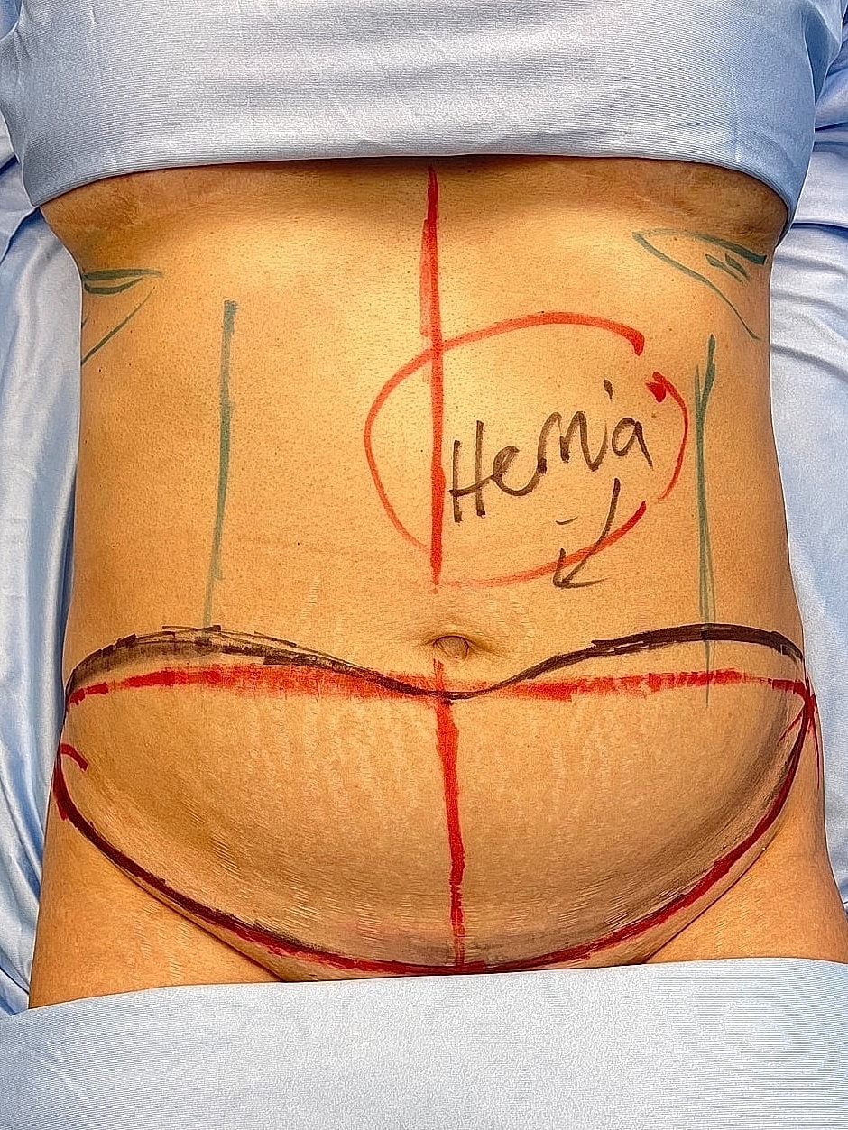 Marked abdomen indicating hernia surgery preparation.