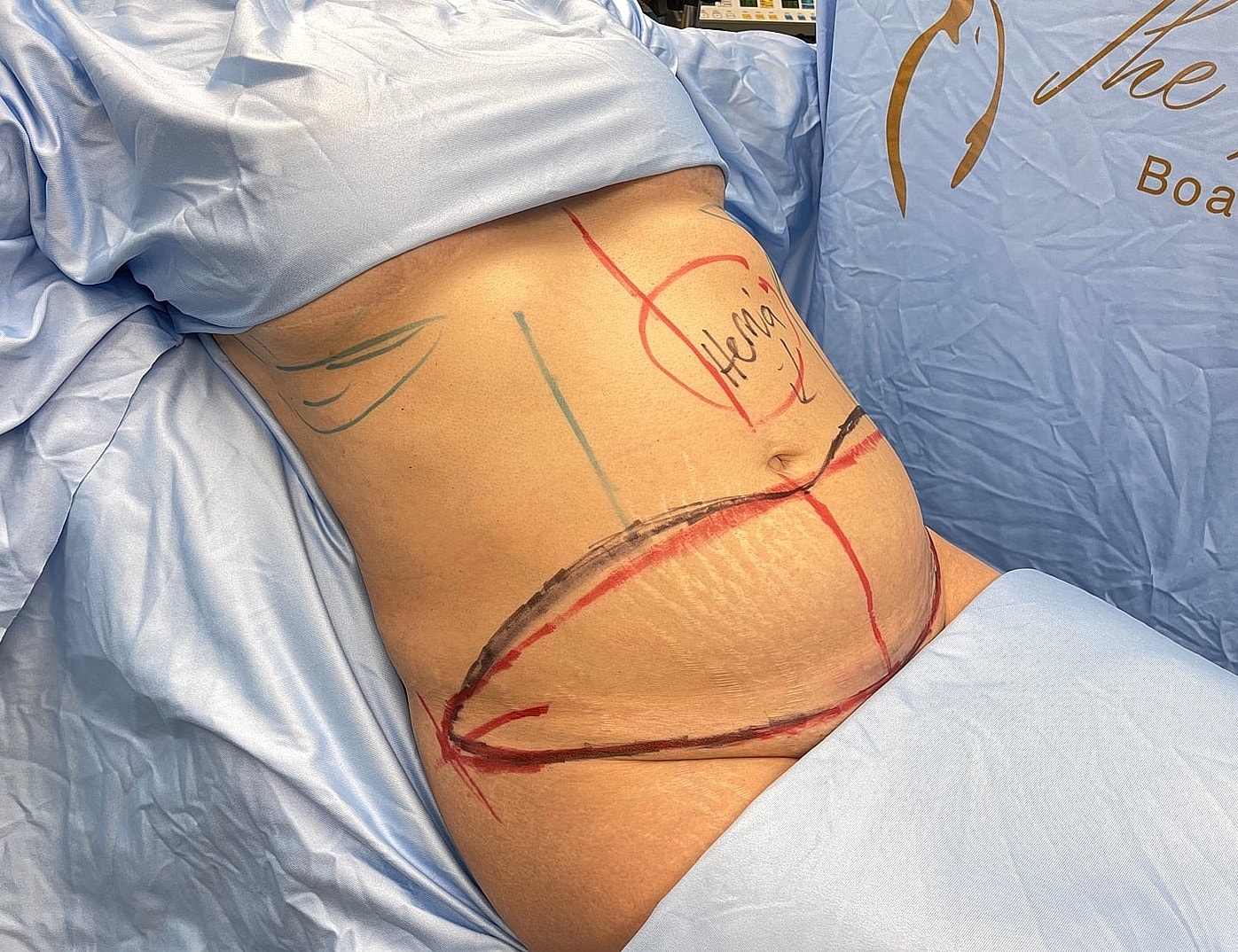 Surgical markings on abdomen before procedure.