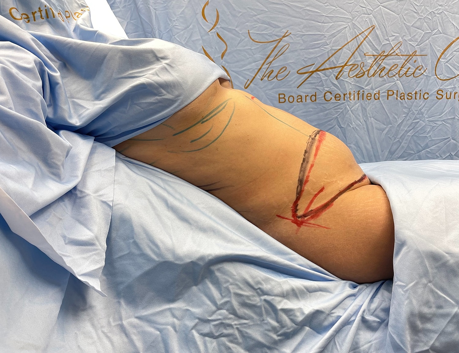 Patient preparation for cosmetic surgery procedure.