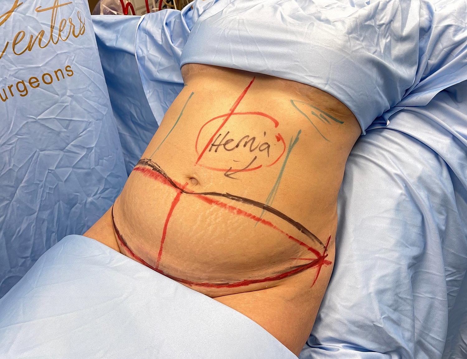Marked abdomen preparing for hernia surgery.