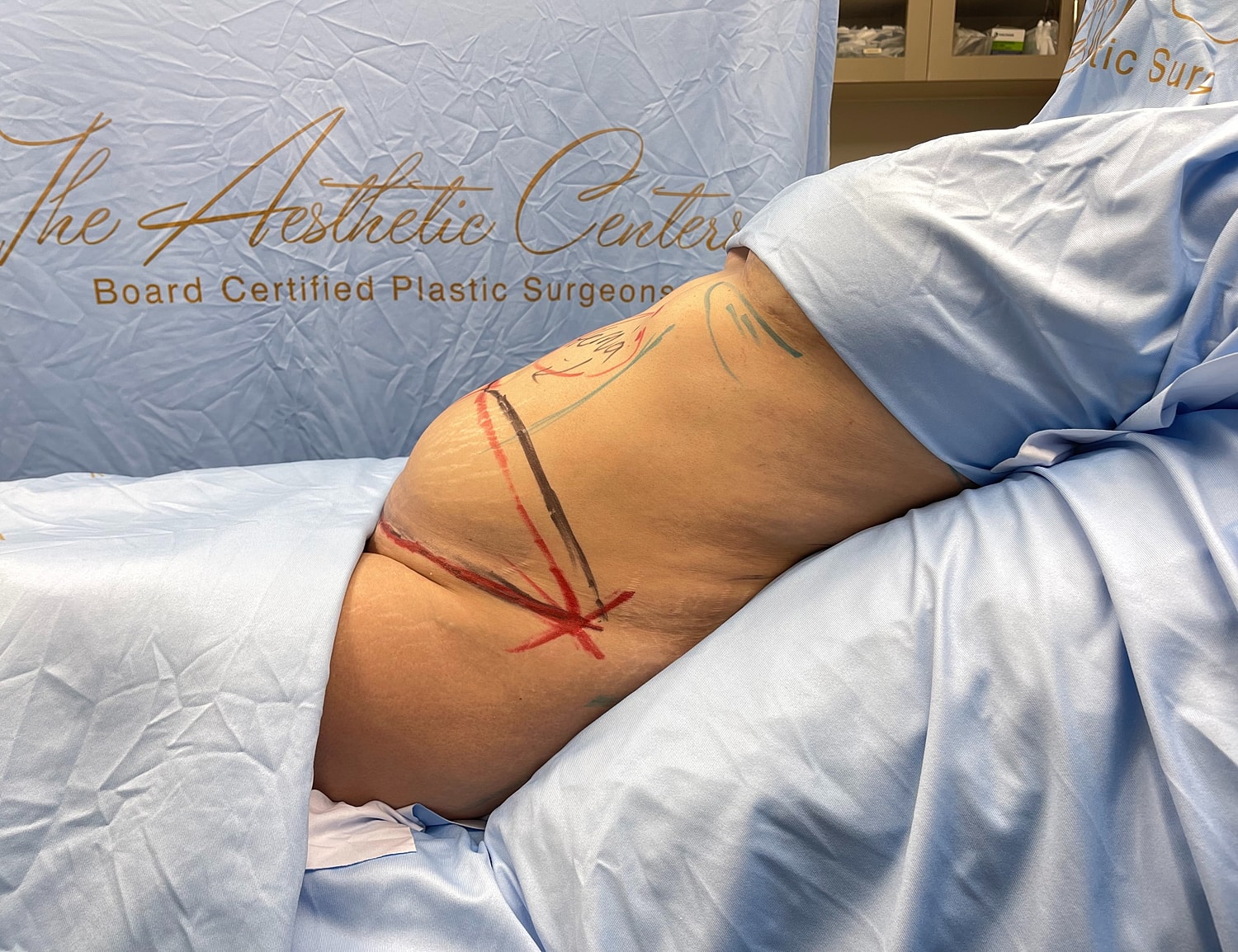 Surgical markings on patient in medical setting.