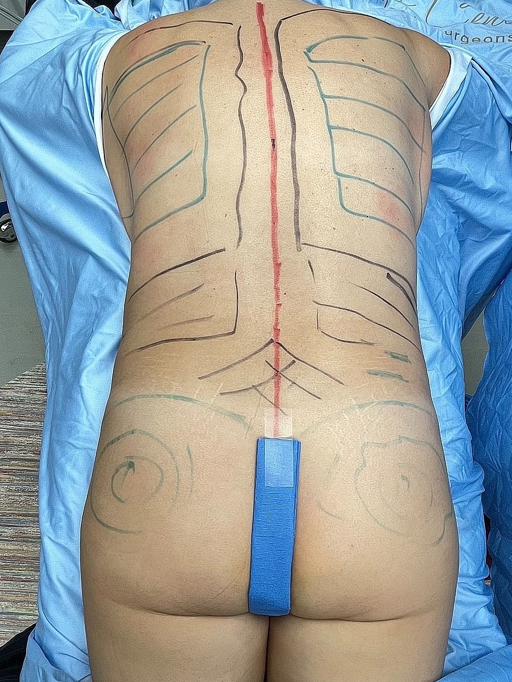 Preoperative markings on a patient's back.