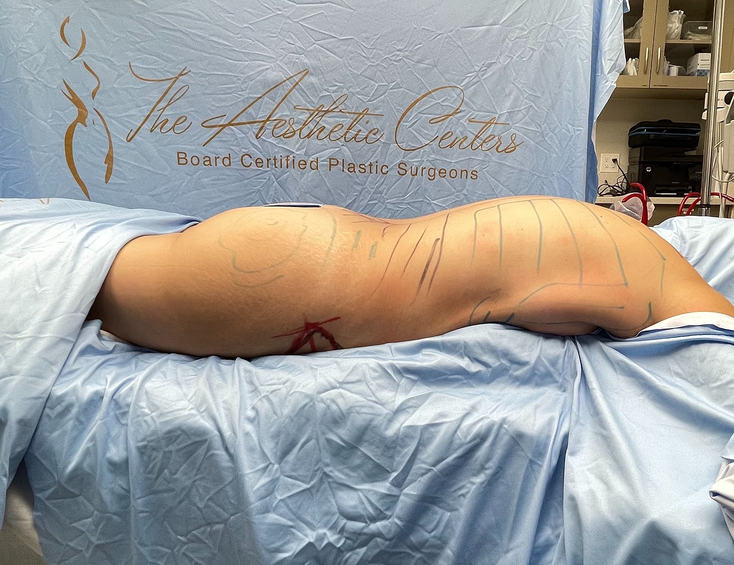 Patient preparation for aesthetic surgery procedure.