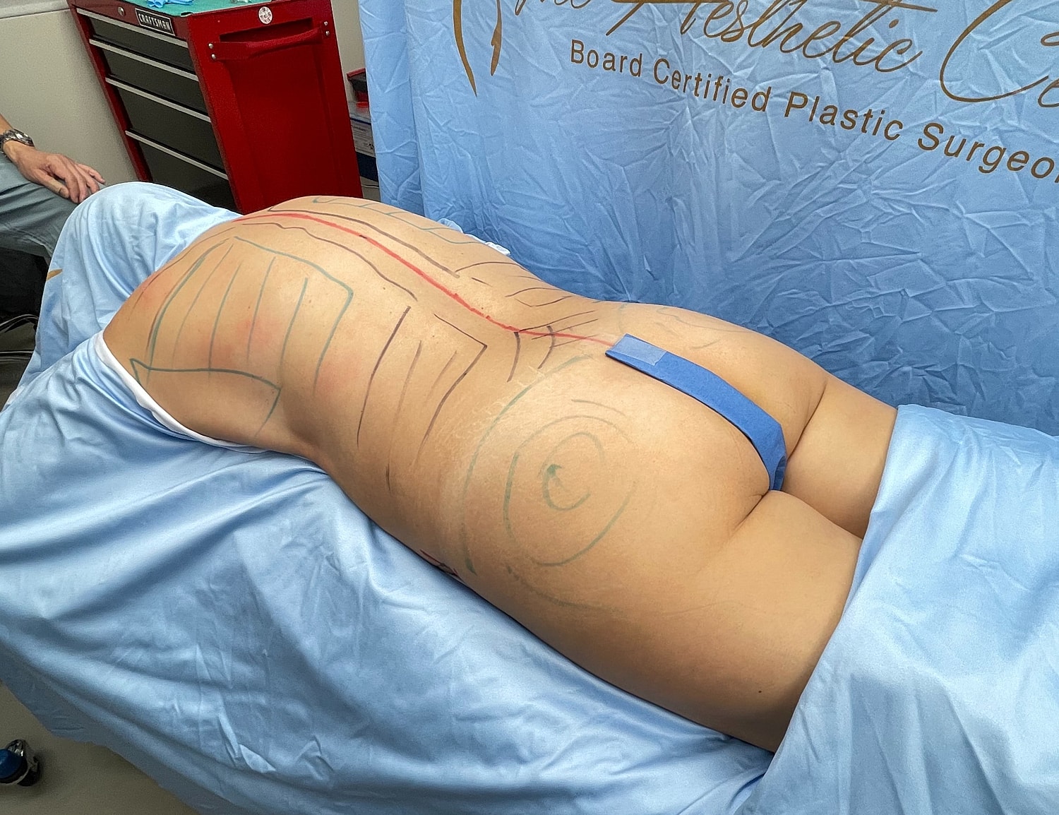 Body contouring preparation with markings on skin.