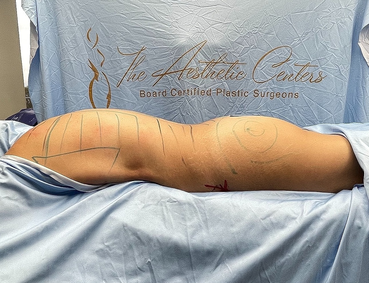 Body contouring procedure preparation on operating table.