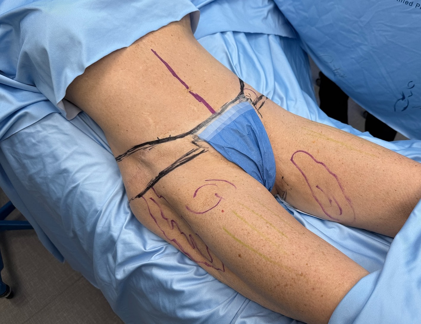 Surgical markings on patient’s abdomen and thighs.