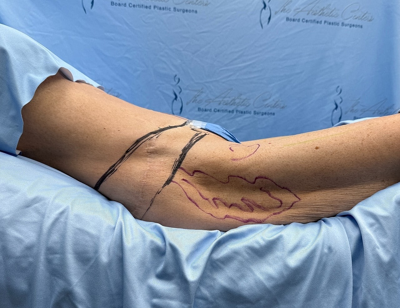 Marked leg preparation for surgical procedure.