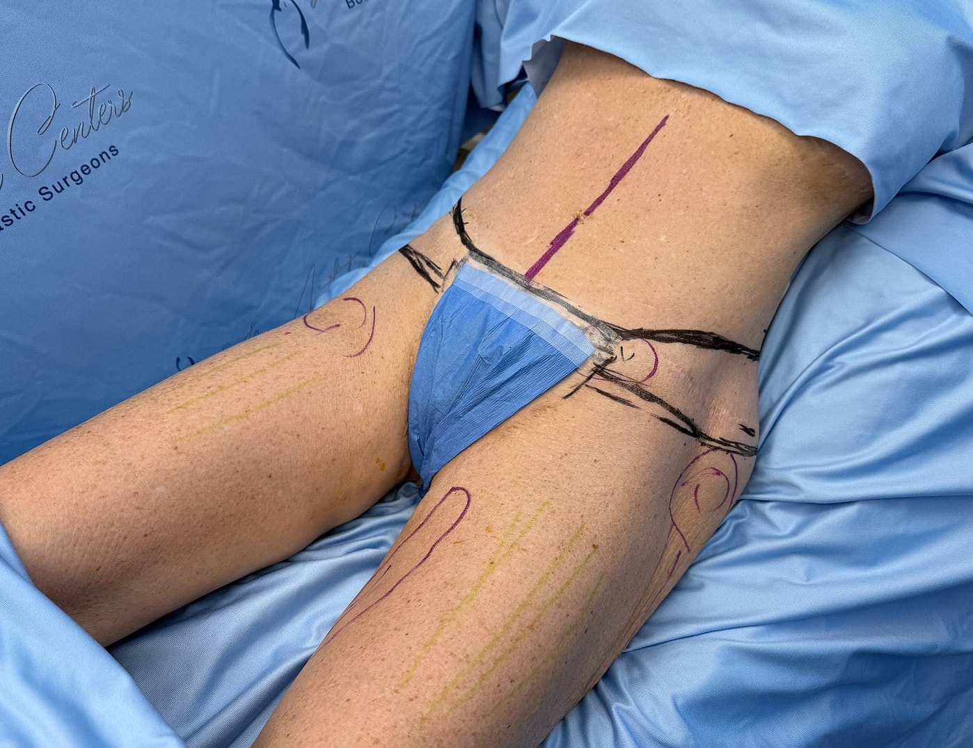 Patient preparation for cosmetic surgery procedure.